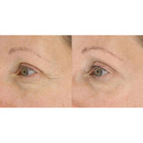 LightStim For Wrinkles